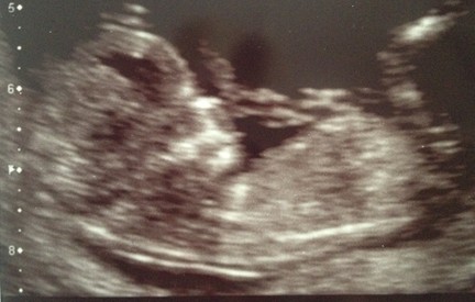 Name:  Baby Seu 12 weeks.rsz.JPG
Views: 141
Size:  32.0 KB