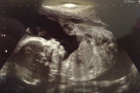 Name:  Baby Seu 20 weeks.1.JPG
Views: 305
Size:  54.7 KB