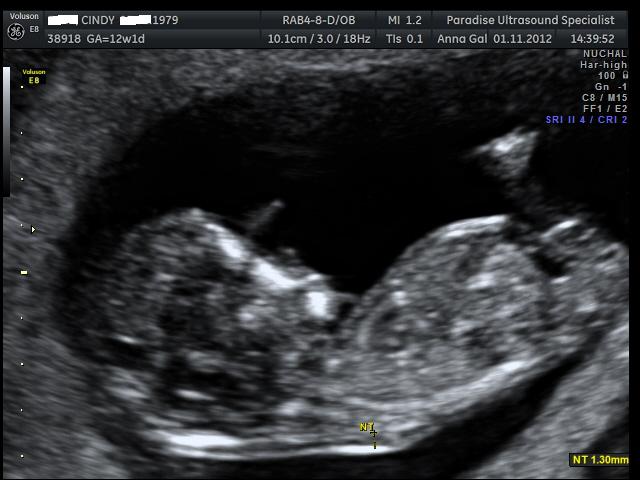 Name:  12weekscan 011.jpg
Views: 625
Size:  48.2 KB