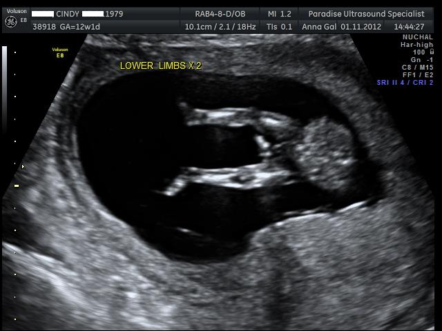 Name:  12weekscan 028.jpg
Views: 727
Size:  50.5 KB
