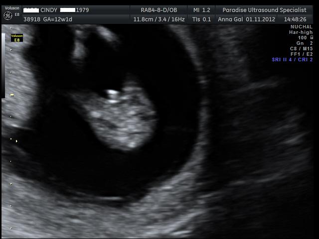 Name:  12weekscan 032.jpg
Views: 622
Size:  37.4 KB