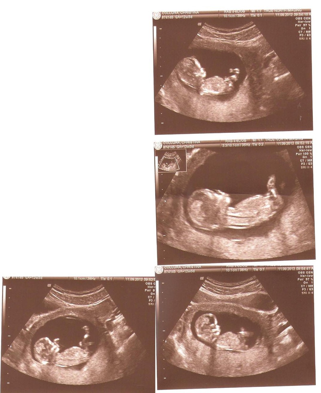 Name:  ultrasound212weeks.jpg
Views: 1076
Size:  246.8 KB