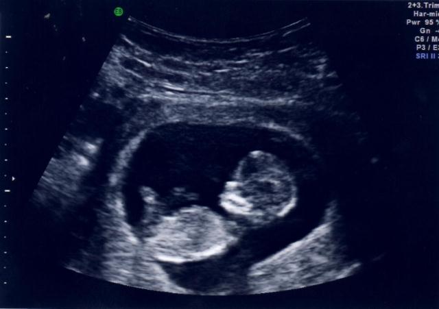 Name:  Baby B 2.jpg
Views: 180
Size:  27.4 KB