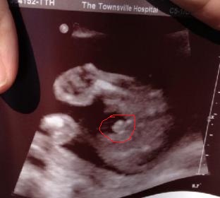 Name:  babygender20wk.jpg
Views: 367
Size:  18.8 KB
