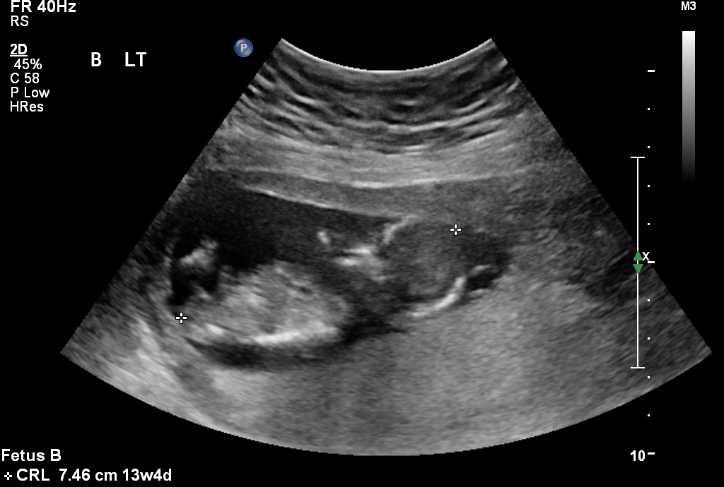 Name:  Baby B nub shot(3).jpg
Views: 1225
Size:  201.6 KB