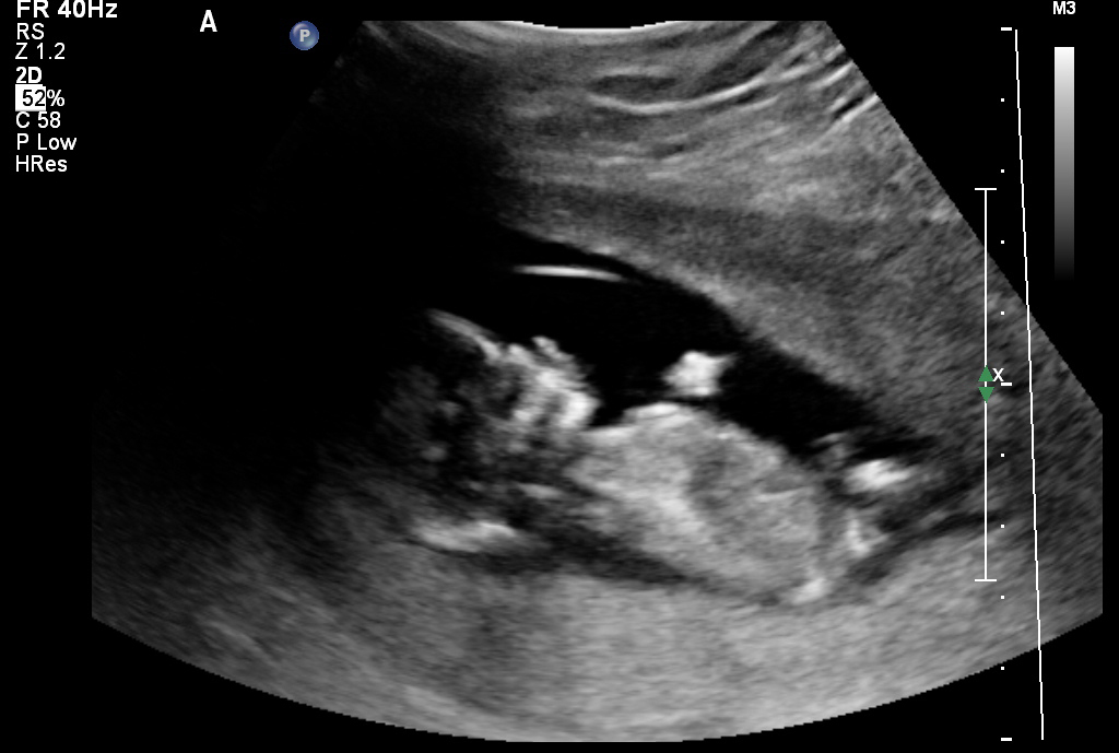 Name:  Baby A nub shot(1).jpg
Views: 965
Size:  190.7 KB