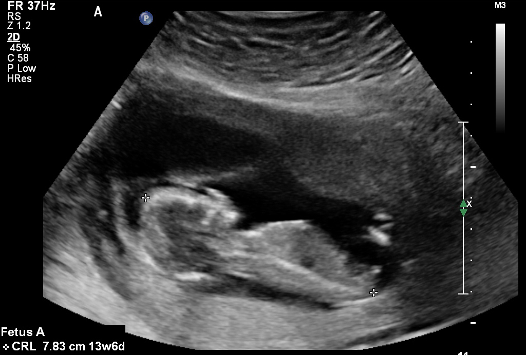 Name:  Baby A nub shot(2).jpg
Views: 4788
Size:  233.3 KB