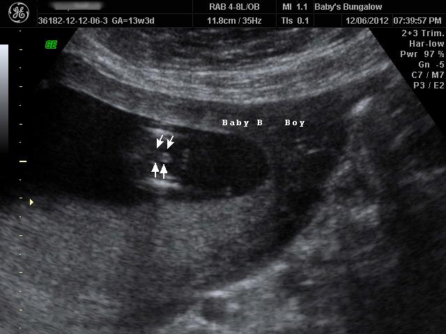 Name:  Baby B - BOY.jpg
Views: 490
Size:  43.8 KB