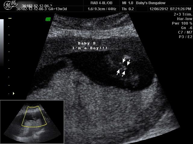Name:  Baby B - BOY(2).jpg
Views: 383
Size:  45.5 KB