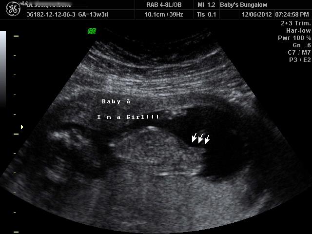 Name:  Baby A - GIRL.jpg
Views: 415
Size:  39.4 KB