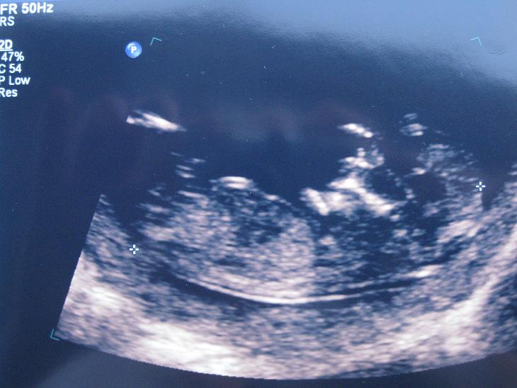 Name:  Ultrasound - resized.jpg
Views: 291
Size:  56.1 KB