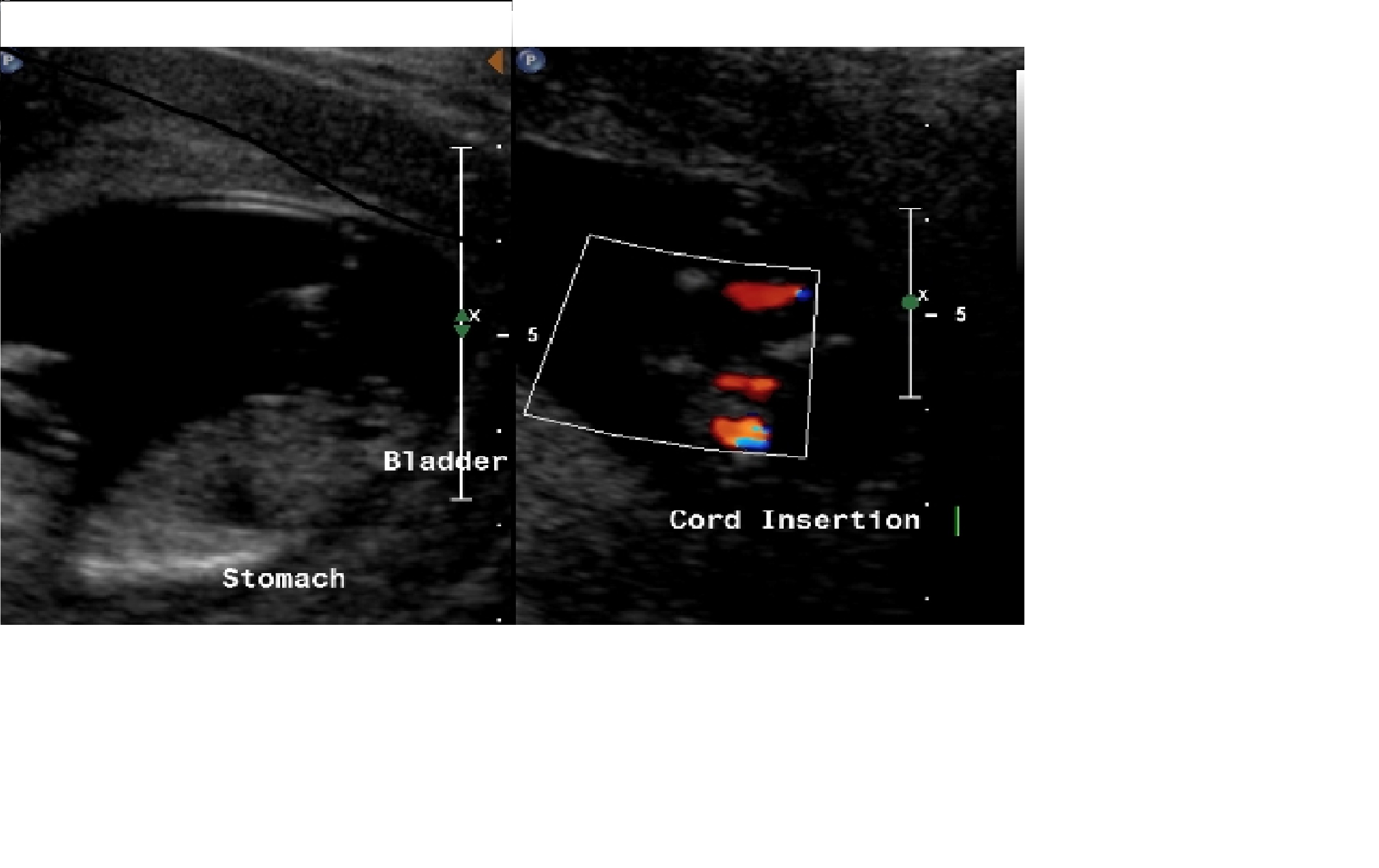 Name:  Ultrasound12w4dx2.jpg
Views: 328
Size:  379.3 KB
