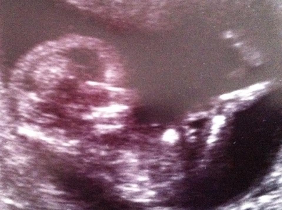 Name:  baby5!13wks.jpg
Views: 82
Size:  97.8 KB