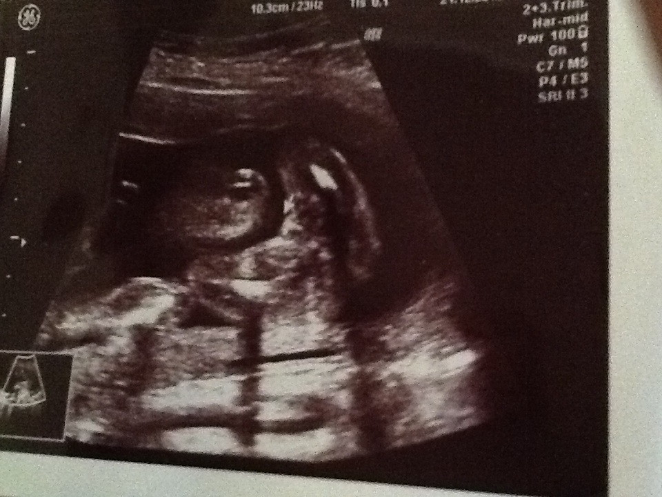 Name:  ultrasound 20+5.jpg
Views: 138
Size:  185.1 KB