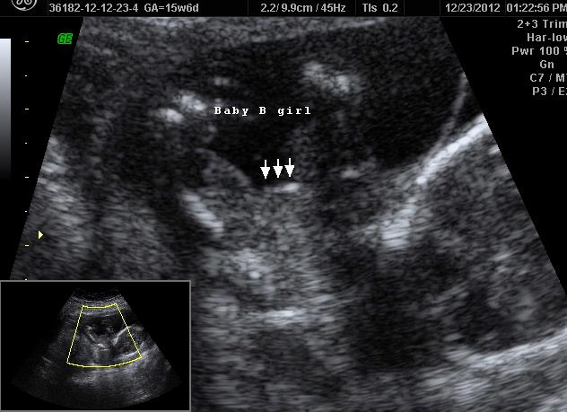 Name:  Baby B is GIRL.jpg
Views: 171
Size:  46.2 KB
