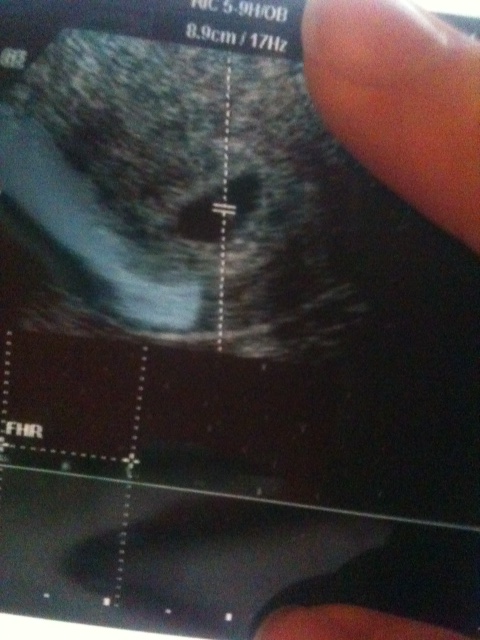 Name:  6week ultrasound.jpg
Views: 5115
Size:  124.1 KB