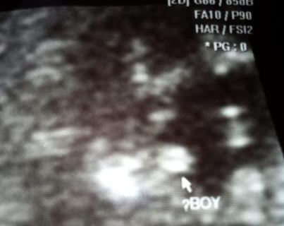 Name:  12 week ultrasound.jpg
Views: 414
Size:  67.7 KB