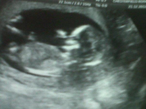 Name:  my baby scan.jpg
Views: 114
Size:  32.7 KB
