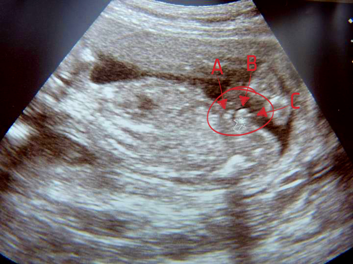 Name:  19 week scan mock up.jpg
Views: 121
Size:  240.6 KB