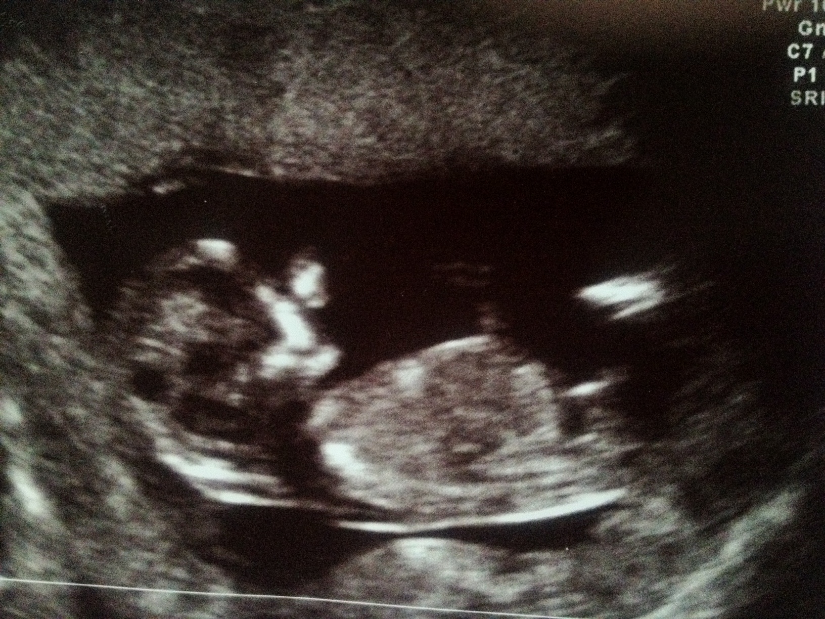 Name:  Baby 2 nub.JPG
Views: 166
Size:  906.8 KB