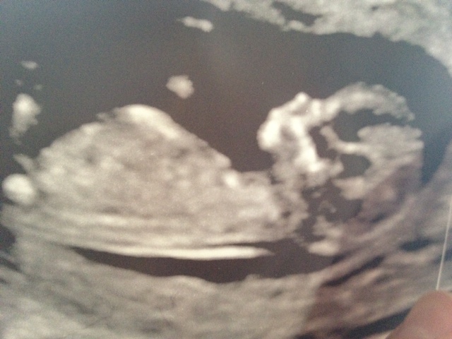 Name:  12 wk sonob.JPG
Views: 246
Size:  106.0 KB