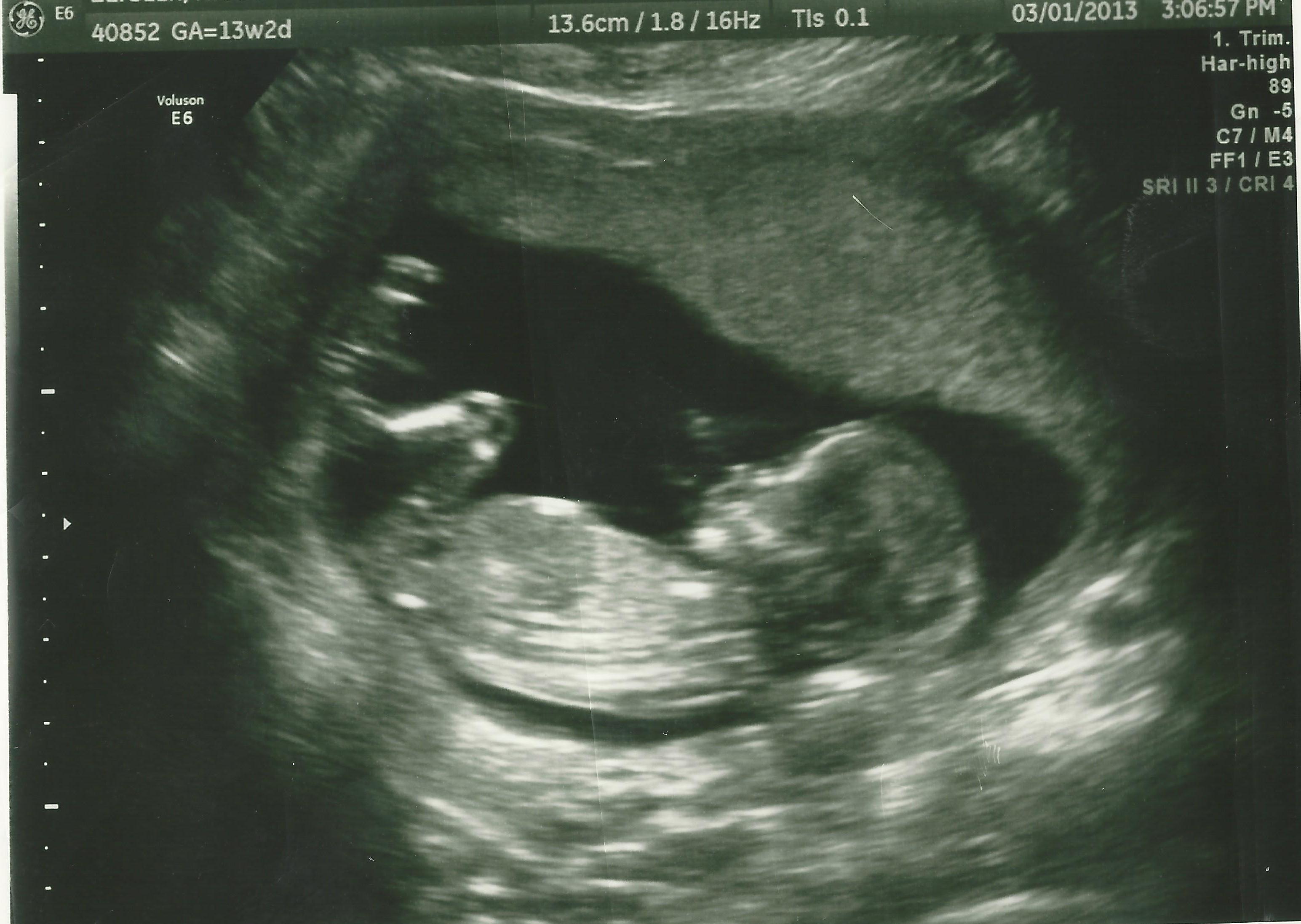 Name:  13 week ultrasound SCANNED photo.jpg
Views: 18185
Size:  385.7 KB