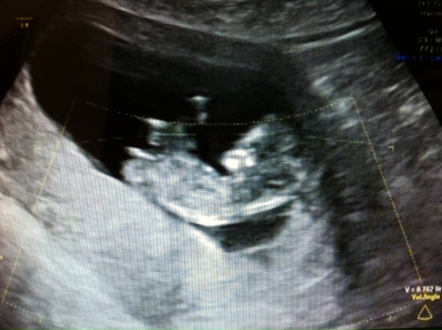 Name:  baby med scan scan.jpg
Views: 604
Size:  104.8 KB
