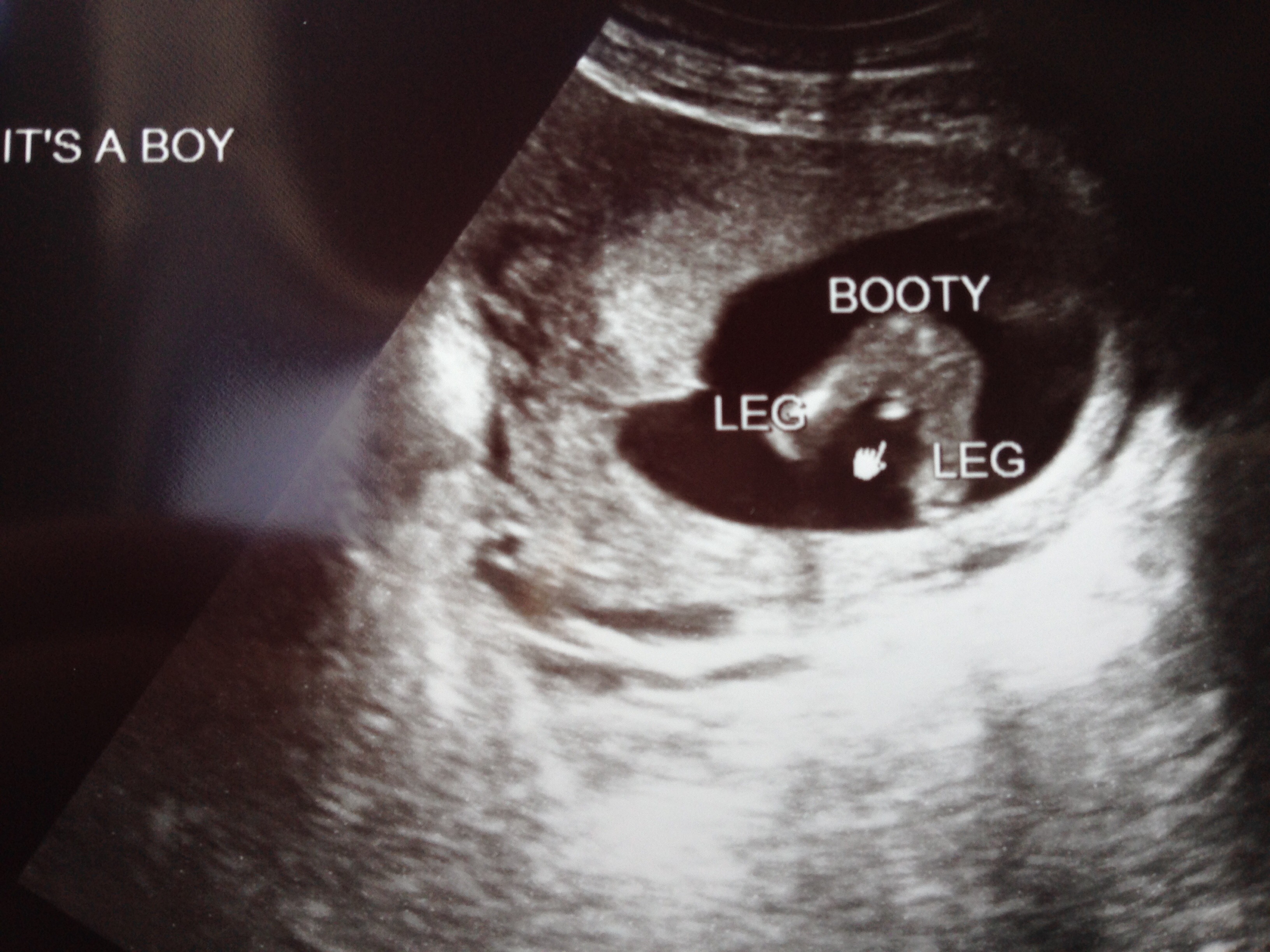 Ultrasound pictures of confirmed boy but worried it could ...