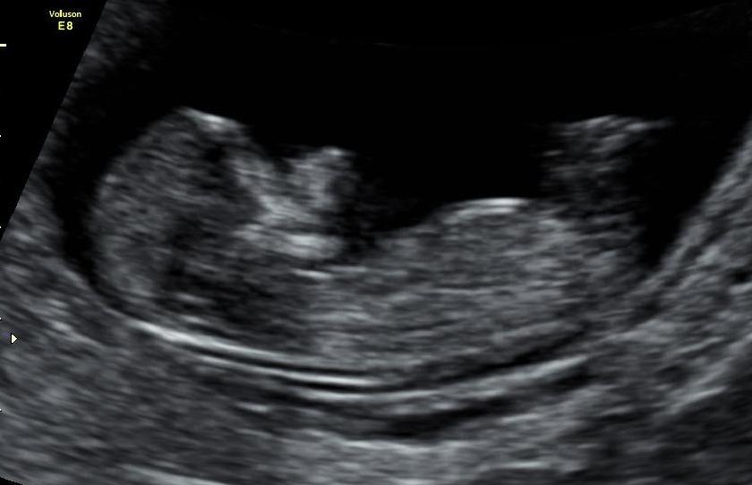 Name:  Baby Nub Photo.JPG
Views: 531
Size:  37.0 KB