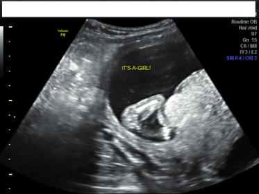 Name:  ultrasoun.jpg
Views: 386
Size:  15.5 KB