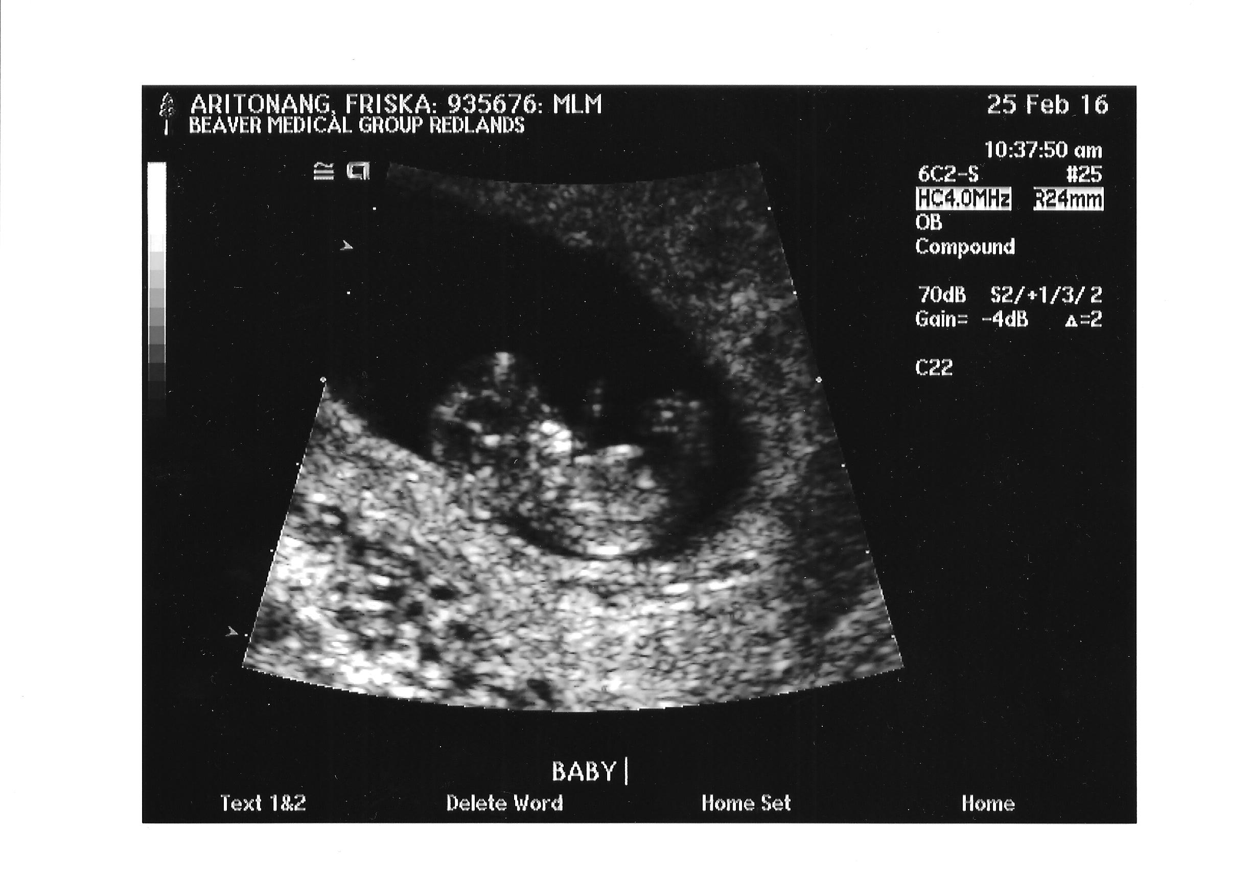 9 week sonogram