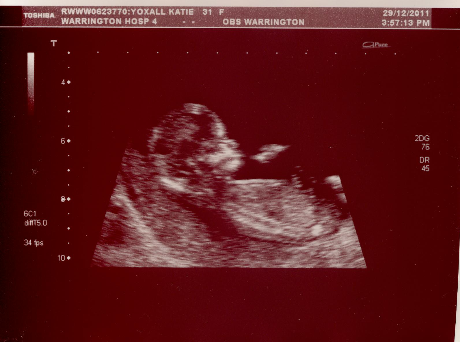 Name:  Baby scan.JPG
Views: 166
Size:  135.4 KB