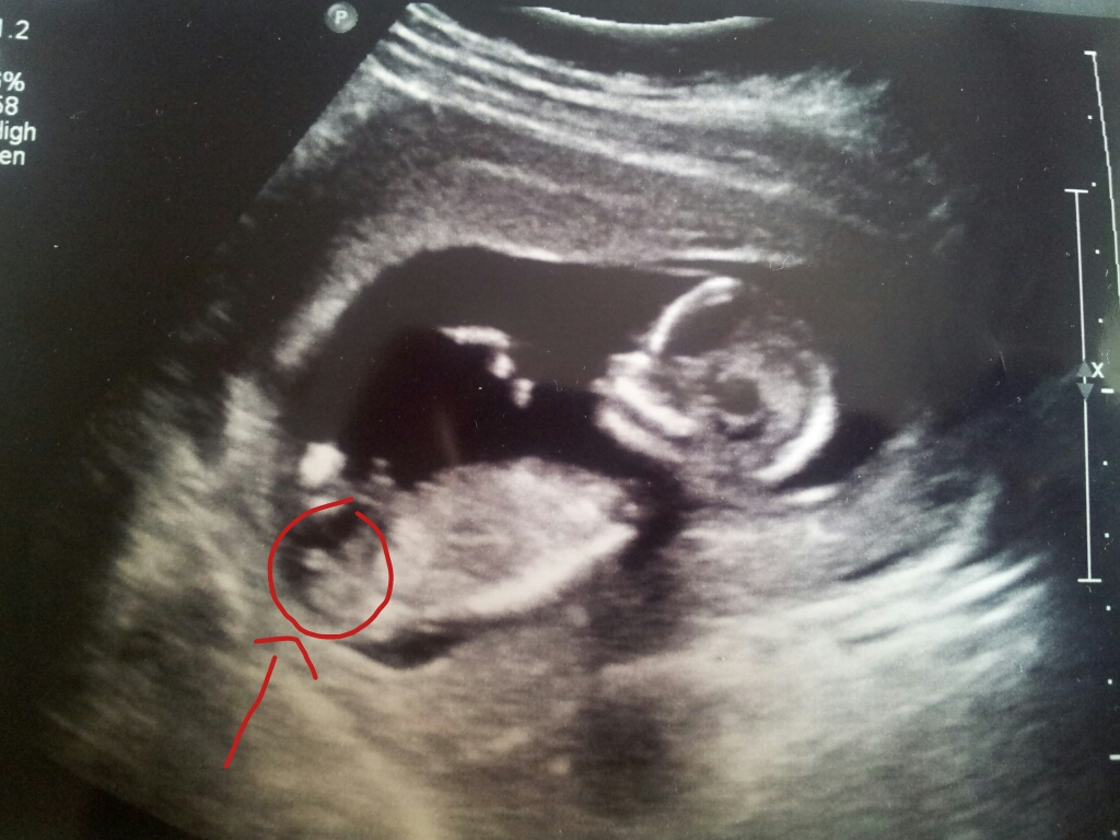 13 Week Ultrasound Pictures Gender