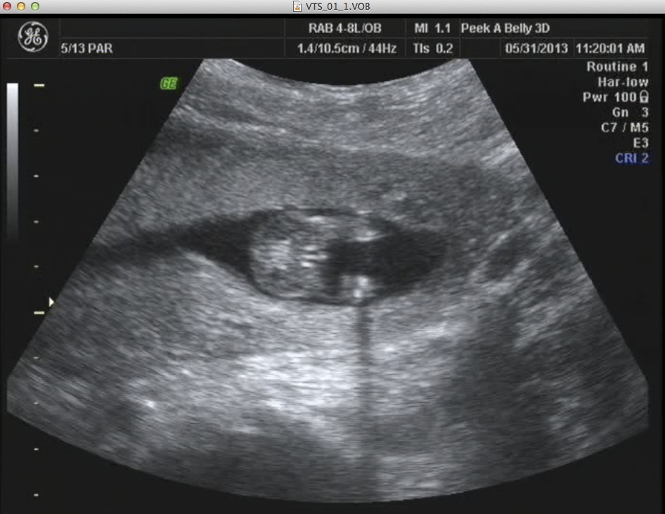 14 week u/s pointed to boy, 20 week u/s leaning towards girl. . . .need