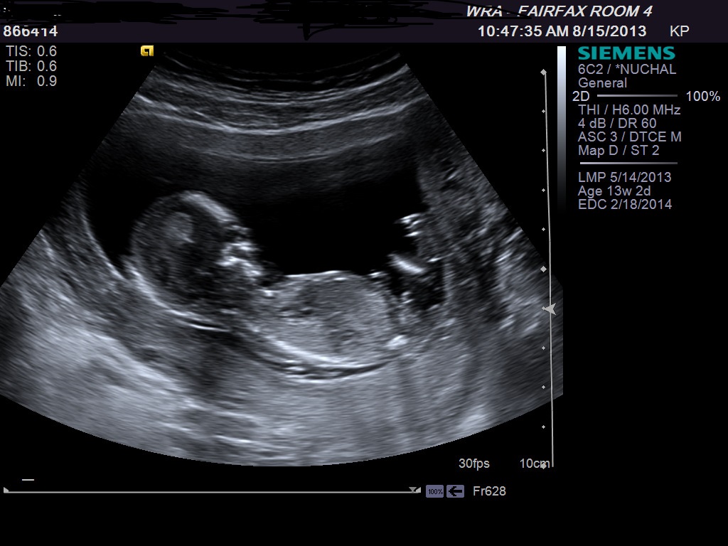 Name:  ultrasound 3 at 13 weeks.jpg
Views: 89604
Size:  163.8 KB