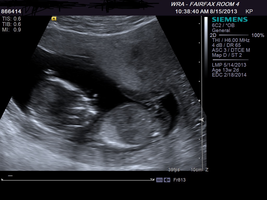 Name:  ultrasound 2 at 13 weeks.jpg
Views: 5235
Size:  148.5 KB