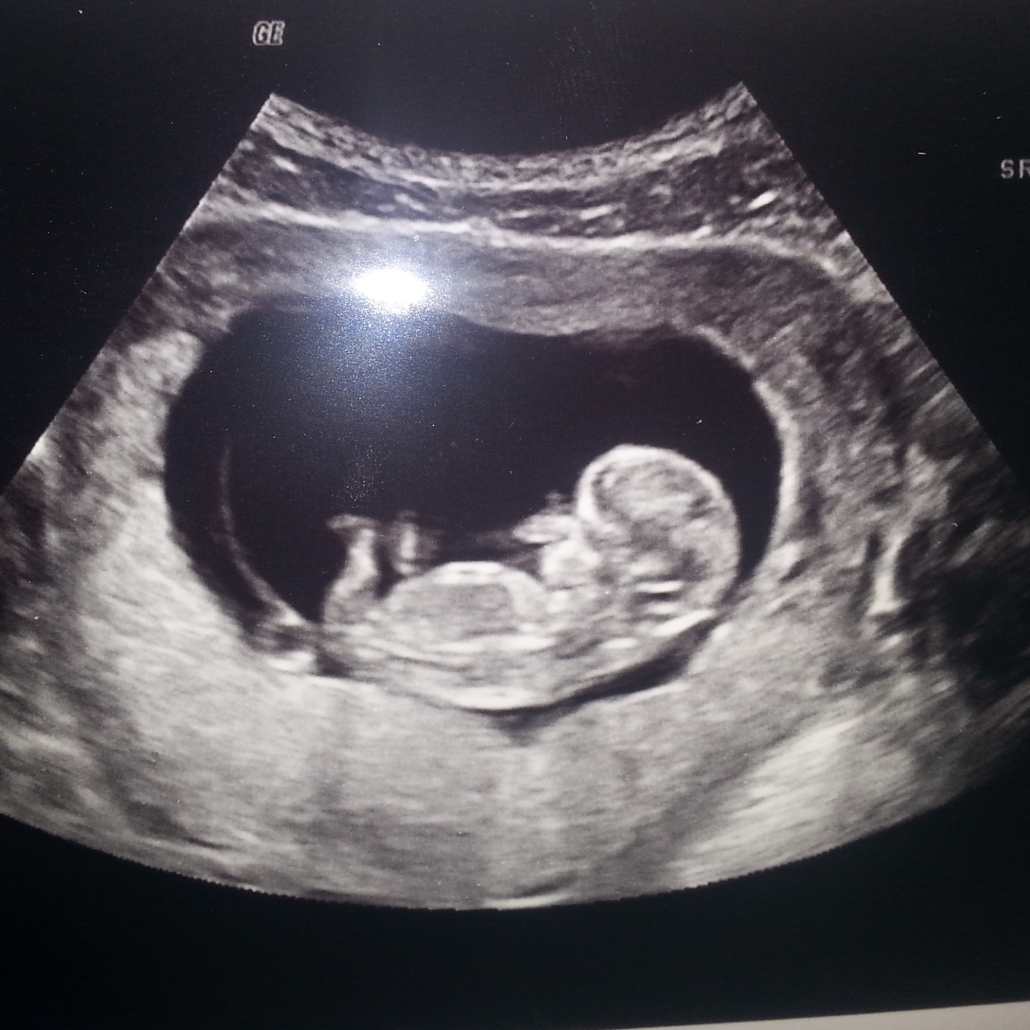 11 weeks pregnant ultrasound heartbeat