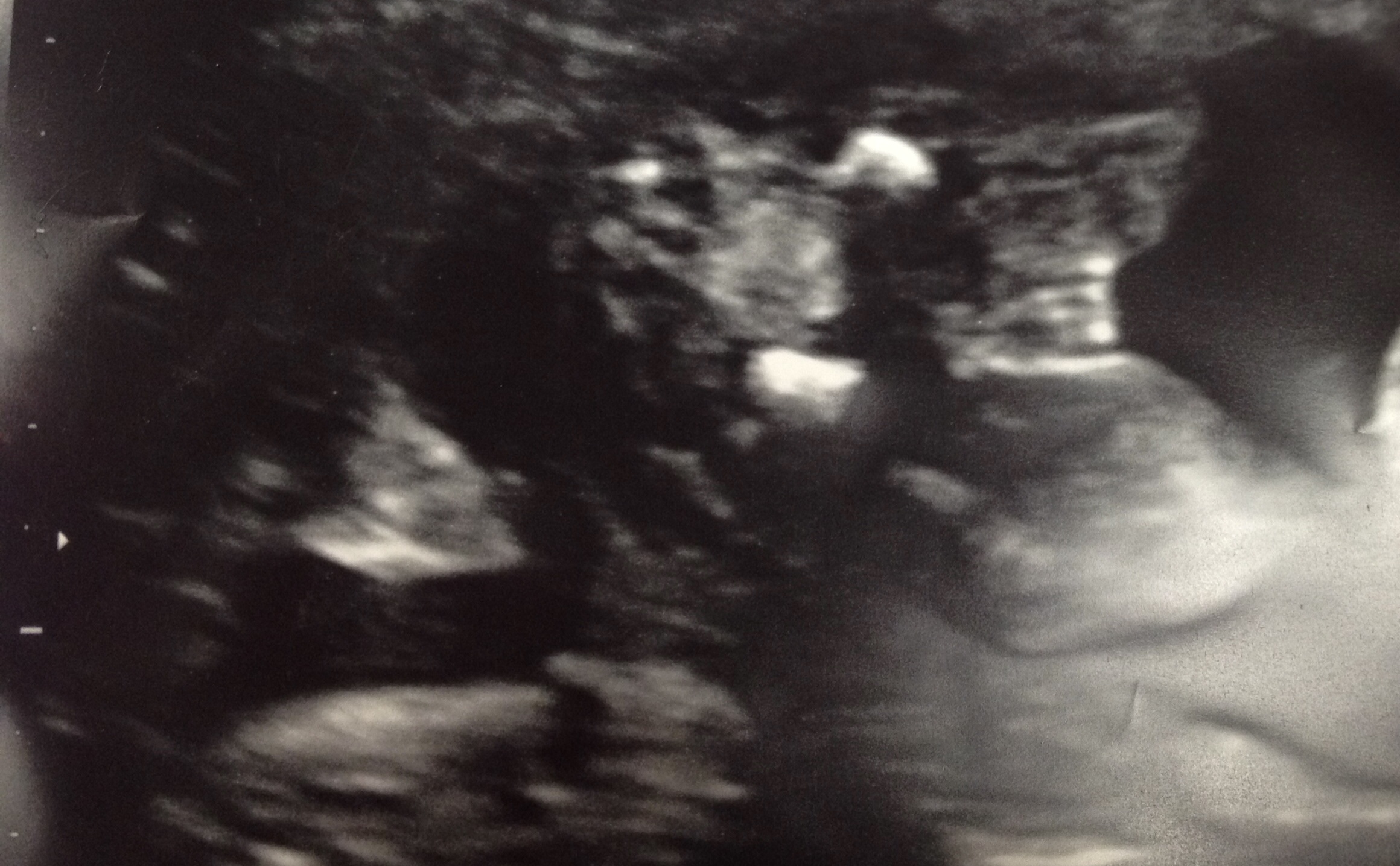 Anatomy Scan Girl or Boy?