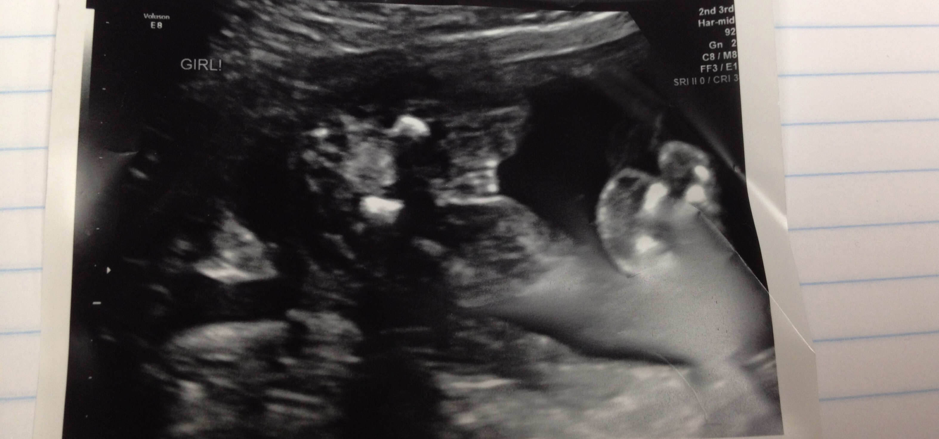 Anatomy Scan Girl or Boy?