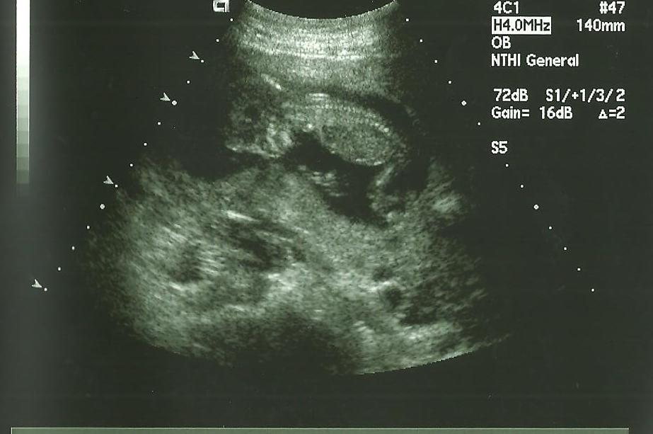Name:  ultrasound.jpg
Views: 57
Size:  65.3 KB