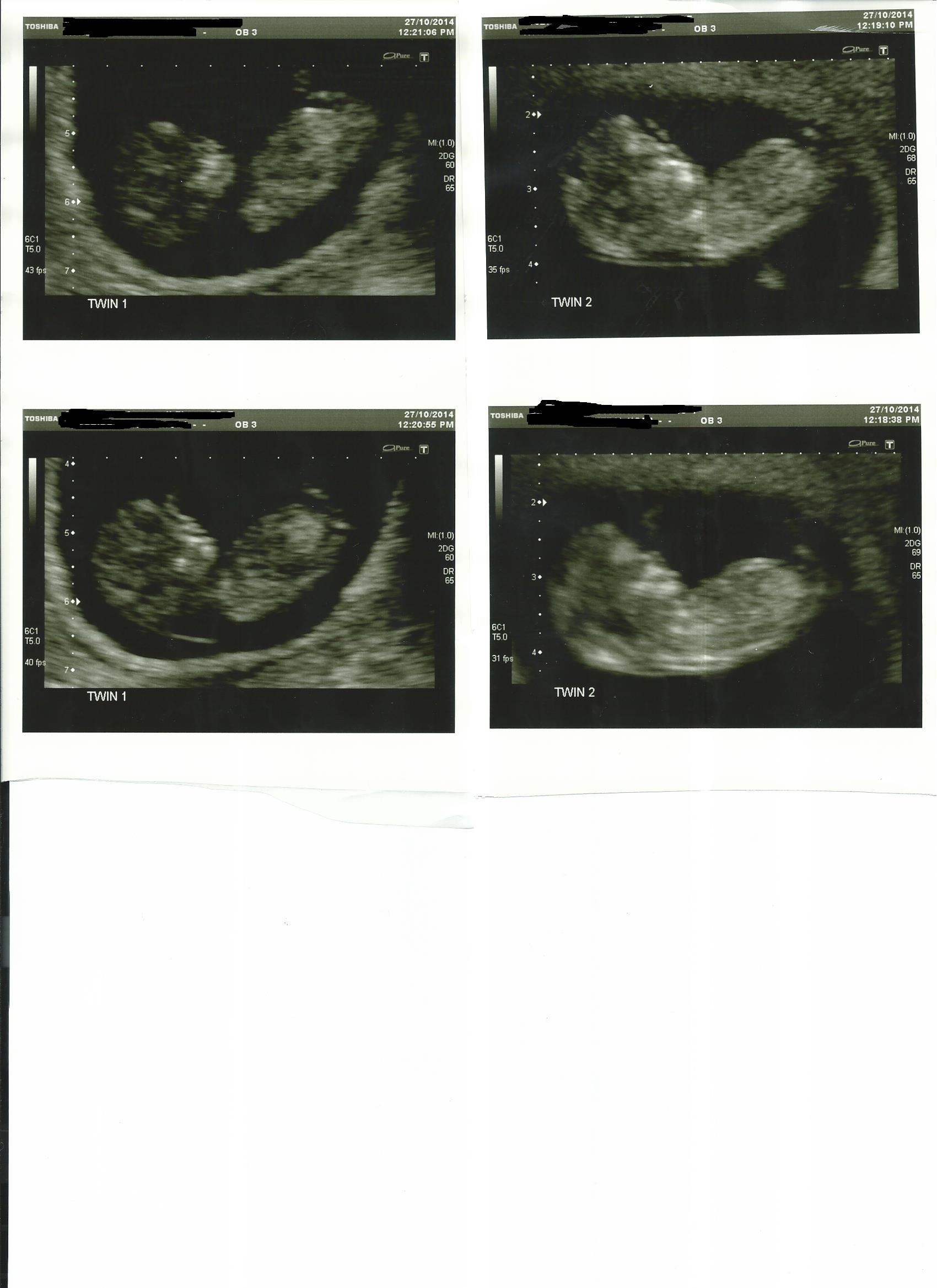 Name:  twin 1 and 2 at  11 week 2 days - new.jpg
Views: 4989
Size:  371.5 KB