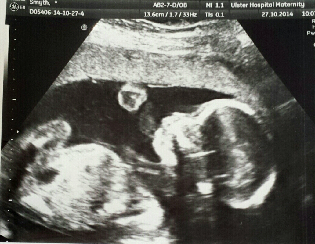 20 week scan - can you tell?!