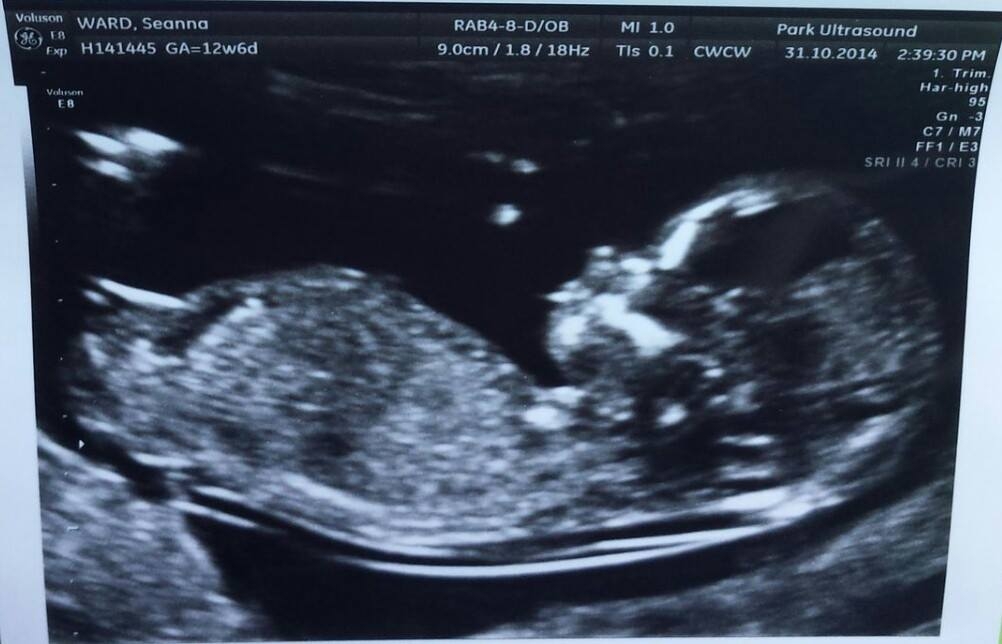12 weeks 6 days nub photo boy or girl???