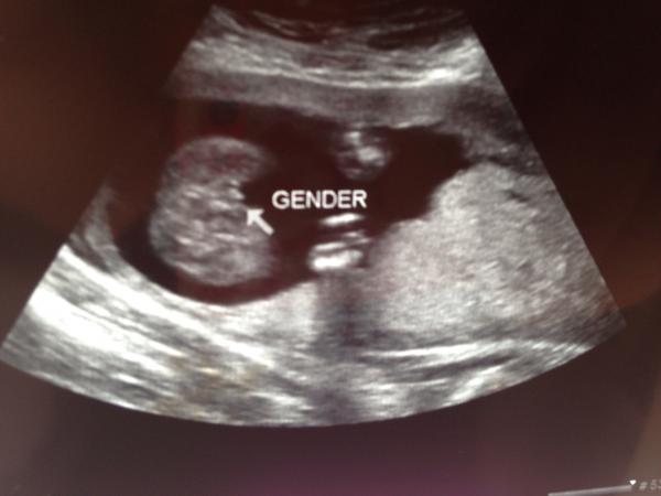 photo of 8 week ultrasound
