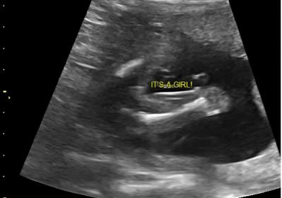 guess my babys gender 19 week ultrasound