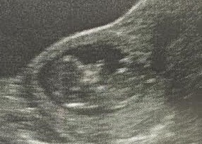 Name:  baby - 12 week scan (2).jpg
Views: 715
Size:  41.3 KB