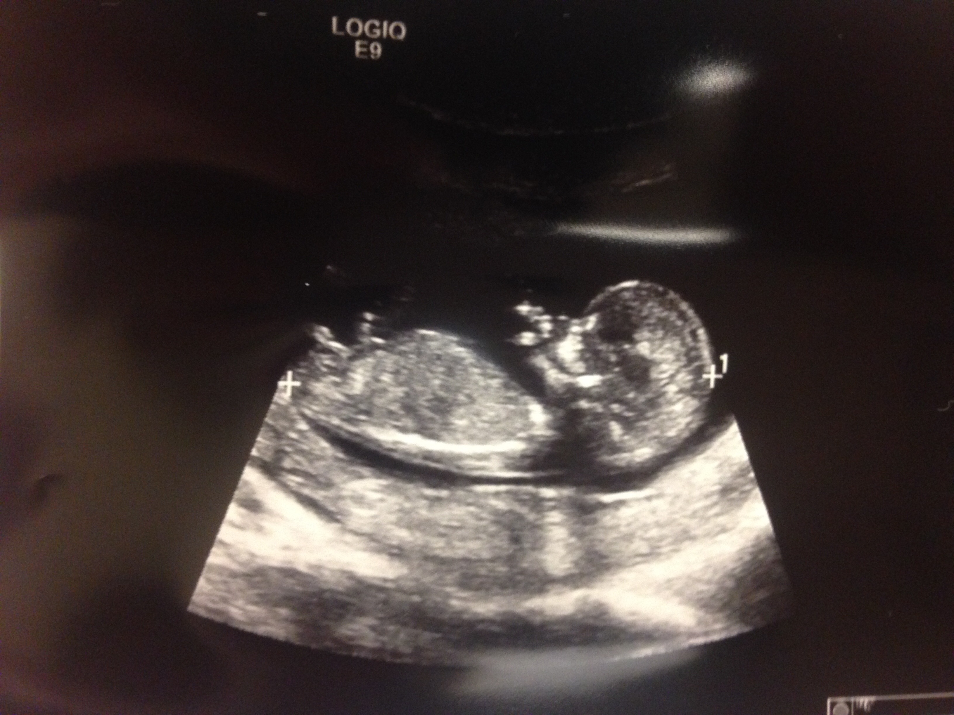 Фото ребенка 13 недель. УЗИ 11-14 недель беременности. Ребенок на 13 неделе беременности УЗИ. УЗИ 11 недель беременности мальчик. Снимок УЗИ 12-13 неделя беременности.