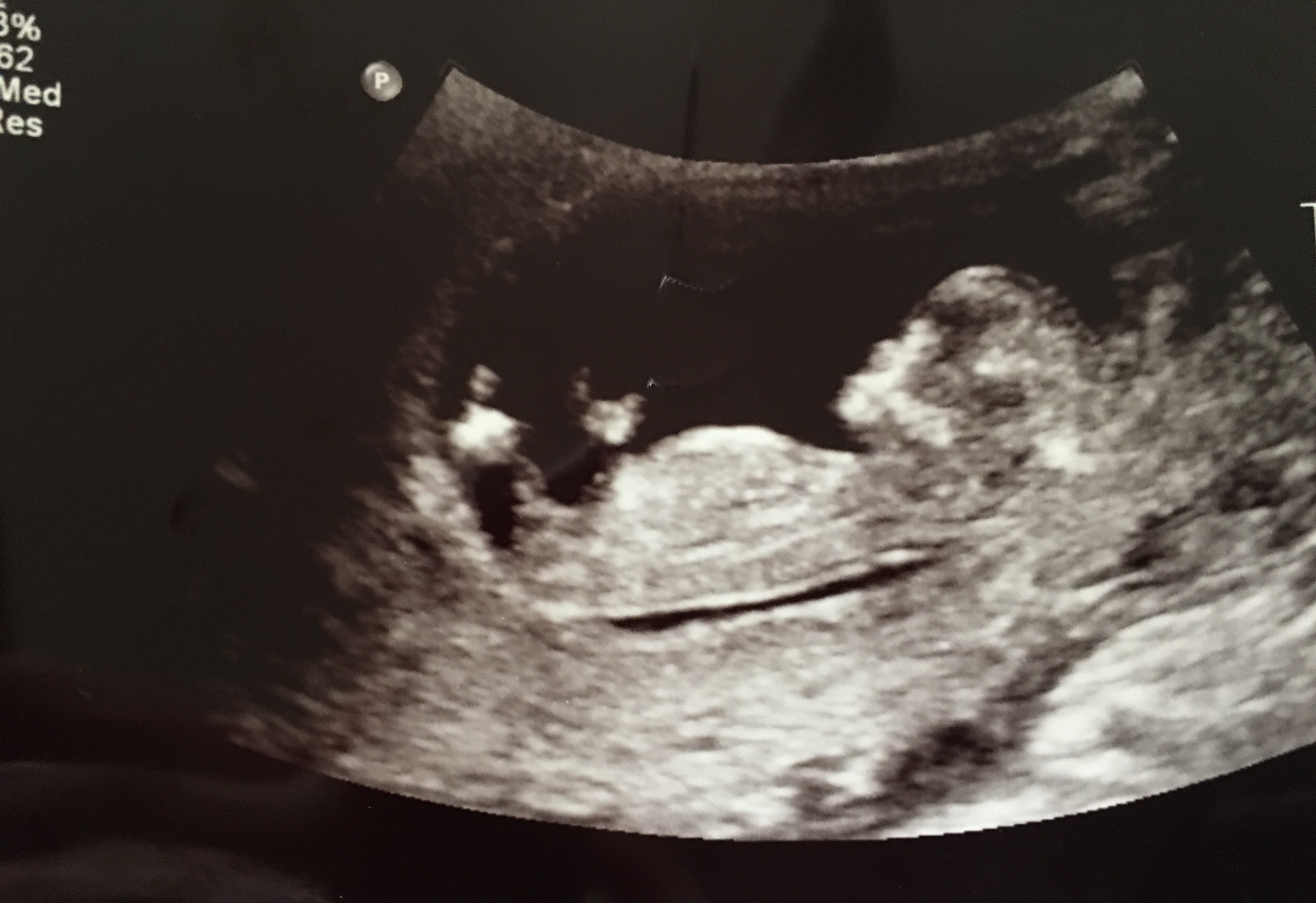 12 week ultrasound! Boy or girl?! Please help!!
