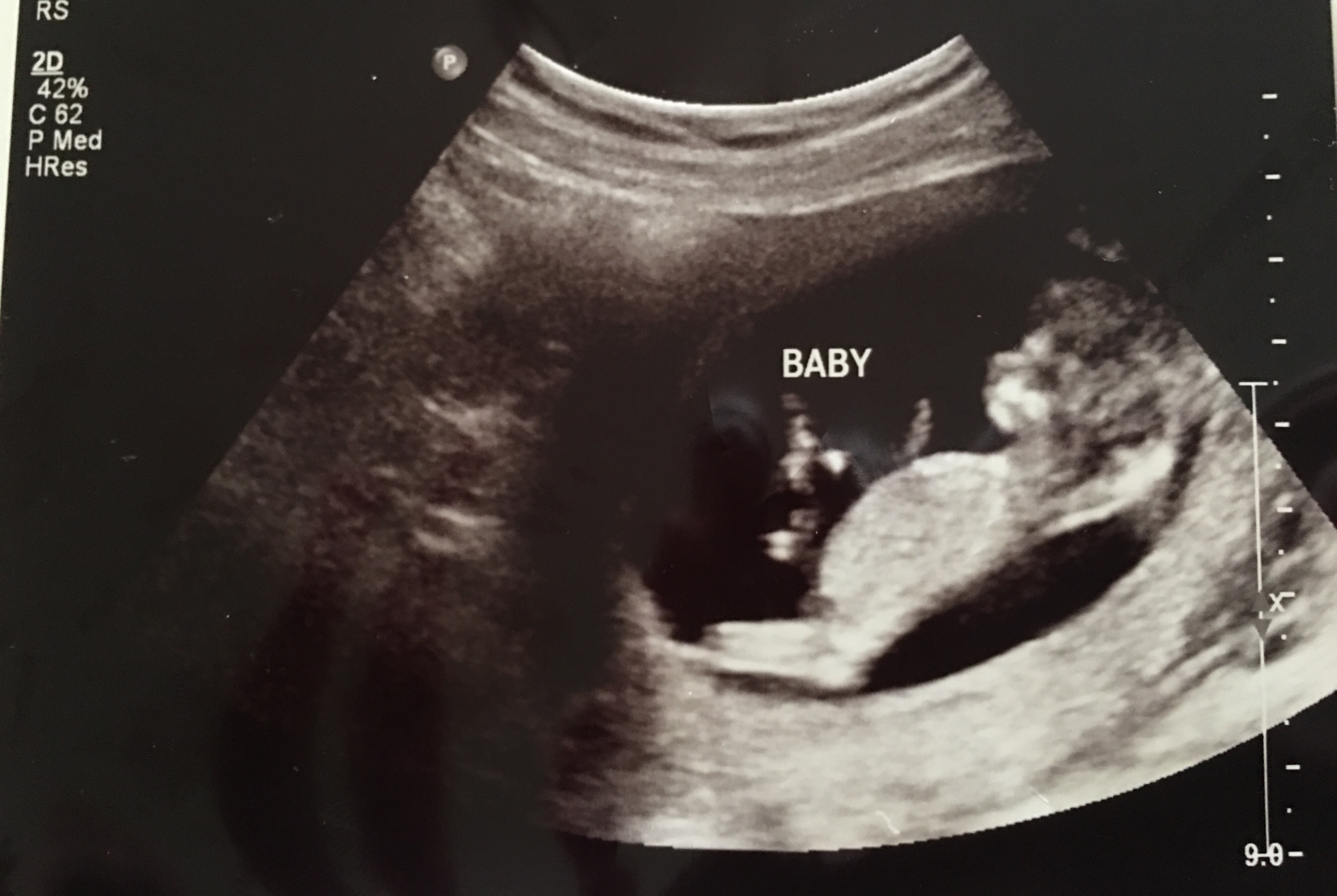 12 week ultrasound! Boy or girl?! Please help!!