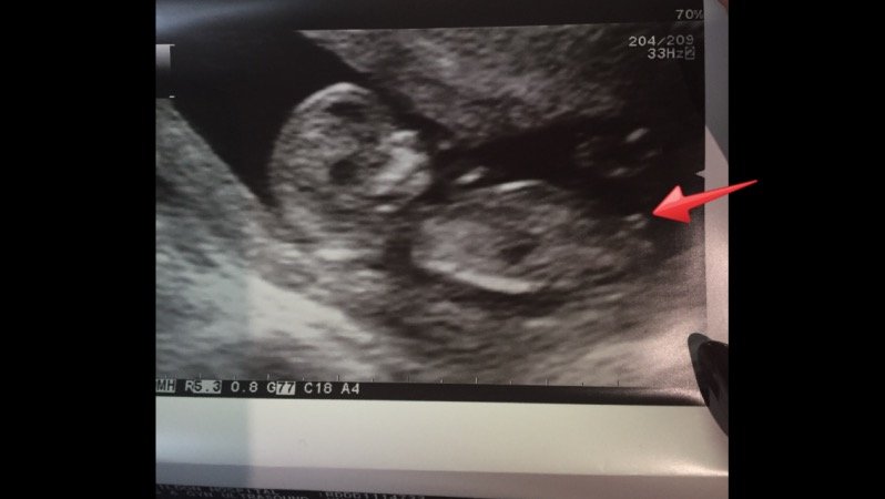 Nub boy or girl? 12 weeks 3 days